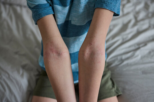 Child's arms with eczema