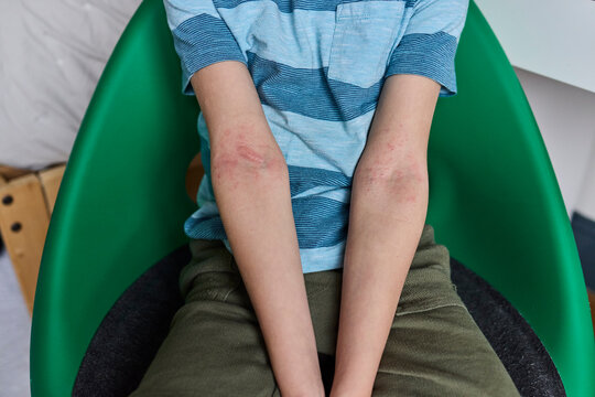 Child's arms with eczema