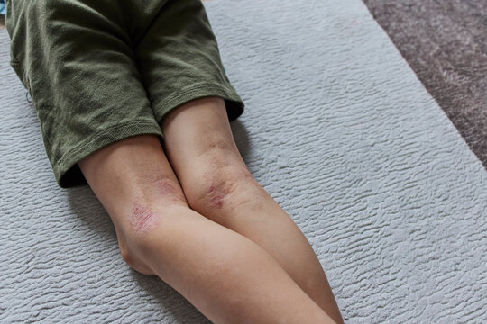 Child's legs with eczema