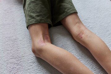 Child's legs with eczema