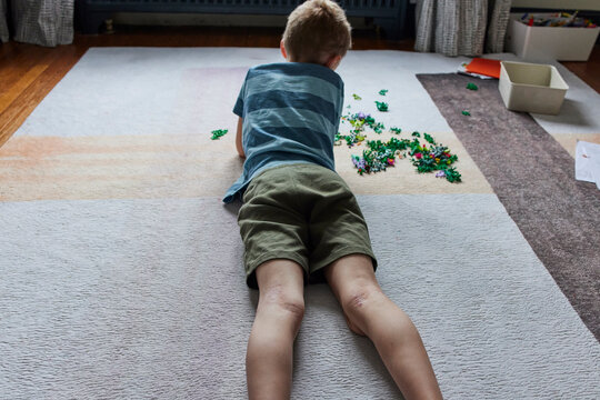 Little boy with eczema lays on a rug