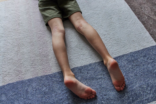 Child's legs with eczema