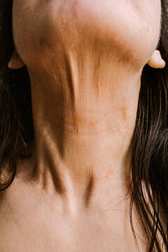 The neck of a woman with skin disease 
