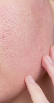 Vertical. Close-up of human cheek with prominent pores, redness, skin inflammation, sensitive or problem skin. Hand touching skin, concept of care, diagnosis or dermatology problems.