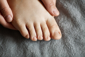 Peeling skin on woman foot after mask