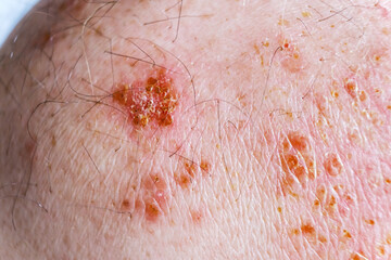 Skin lesion symptom in Shingles or Herpes zoster in person. Viral disease Varicella virus. Painful...