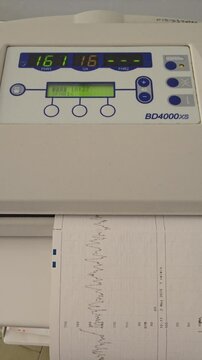This video shows a fetal monitor displaying readings on its digital display, along with a printed strip chart showing fetal heart rate and uterine activity.