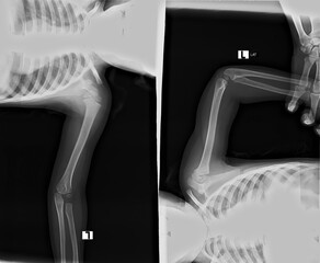 Two X-rays of a person's arm, one showing a broken bone