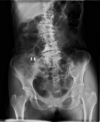 A black and white X-ray of a person's back and pelvis