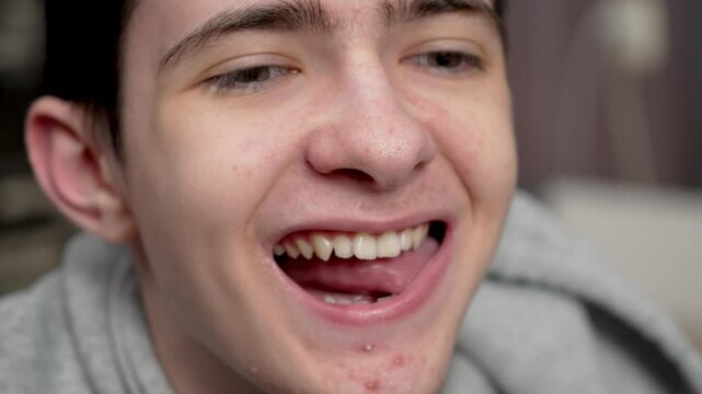 Teenage boy with acne runs tongue over teeth. Adolescent male with blemished skin slides tongue across teeth. Young guy with teenage pimples moves tongue along teeth