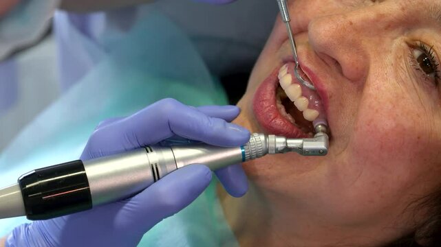 Dentist skillfully polishes upper incisors with prophy cup