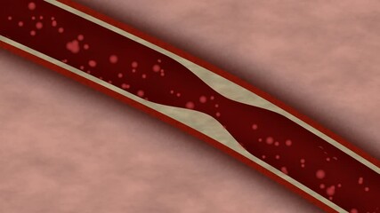 Artery narrowing animation with blood flow
