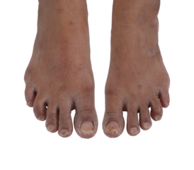 Top view of female cracked and dry feet on transparent background