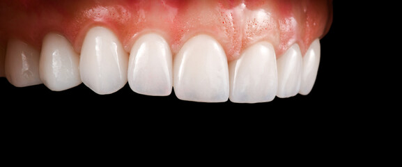 ceramic crowns and veneers