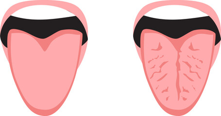 Cartoon illustration showing a close-up comparison between a healthy tongue and a fissured cracked tongue. Educational and medical concept for oral health awareness © Kakigori Studio