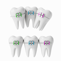 3D rendering of human teeth with colorful orthodontic braces showing comparison between misaligned and straightened teeth on a white background. 3D Rendering