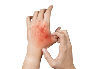 Psoriasis skin, rash and scaling on the patient's skin. The concept of chronic disease treatment.