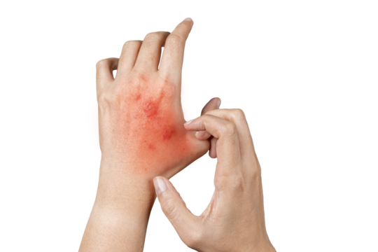 Psoriasis skin, rash and scaling on the patient's skin. The concept of chronic disease treatment.