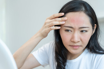 Woman worried about face Dermatology; rosacea dermatitis; allergic steroids; sensitive skin; red face from sunburn; acne; dry skin; large pores; rash face; dull; freckles; wrinkle; skin problem
