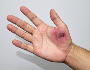 A burn on the hand presents redness and peeling.