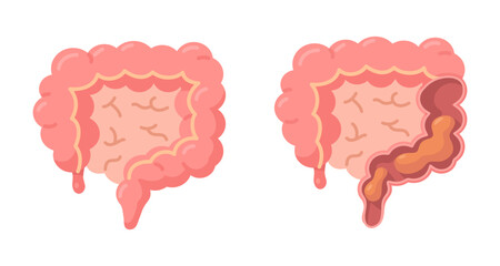 Illustration of Healthy vs. Unhealthy Intestines