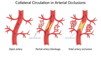 blood flow changes in artery from open flow to partial blockage and total occlusion, highlighting collateral circulation diagram hand drawn schematic raster illustration. Medical science educational