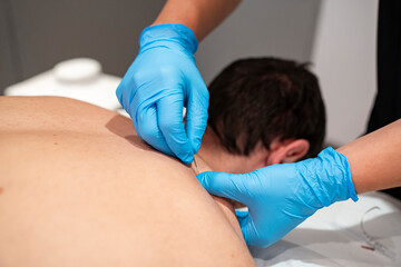 Obraz premium Physiotherapist uses dry needling technique to treat muscle pain and tension