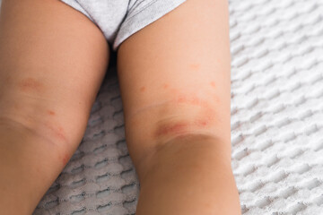 Allergic rash on the legs or feet of the toddler baby girl