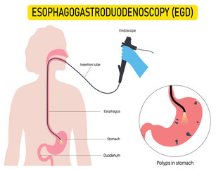 Gastroscopy Medical Vector Illustration – Upper Endoscopy Technique for Visualizing Esophagus, Stomach, and Duodenum