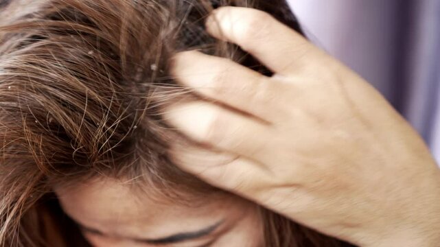 Woman scratching her itchy, dry scalp because of dandruff, oily hair, and sebderm, caused by dry skin, scalp problems, or using strong hair products