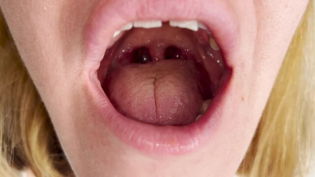 Close up of a adult human open mouth with tongue extended and visible throat, tonsils, and uvula. Medical or dental examination concept with bright lighting.