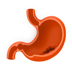 Illustration Of Stomach Cancer