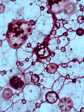 Caseation of human tuberculosis granuloma, light micrograph, photo under microscope. Caseous necrosis, necrotizing granulomatous inflammation