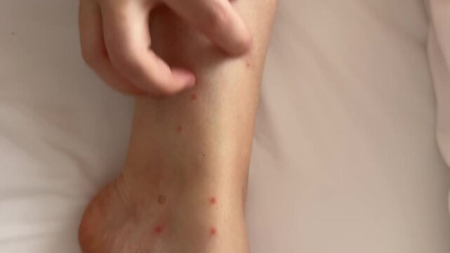 Legs bitten by mosquitoes girl Lying on white sheets get bumps on her skin in the summer