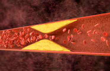 Atherosclerosis with cholesterol blood or plaque in vessel cause of coronary artery disease