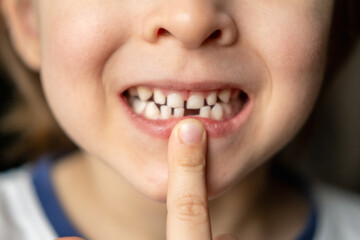 Portrait of little boy with open mouth without one front milk tooth. Loss of baby primary teeth....