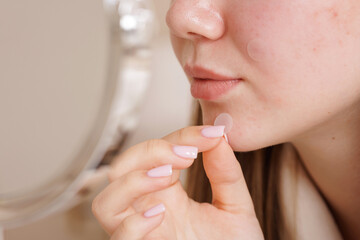 Girl placing acne patch on pimple to heal skin inflammation and improve facial appearance.