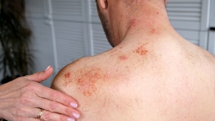 Fototapeta premium A woman applies medicinal ointment to her husband's affected with shingles or Herpes zoster skin. Viral disease Varicella virus. Painful skin rash and pimples. Sun body burn. High quality
