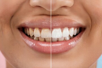 Close-up of a woman's smile before and after teeth whitening, showcasing a dramatic transformation in teeth color and brightness; concept for dental care, cosmetic dentistry, and oral hygiene