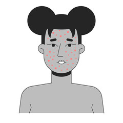 Black woman face with severe acne outline illustration. Pimples, rosacea, pustules. African american female facial skin breakout 2D line character isolated on white. Monochrome vector ink linear image