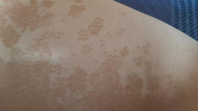 brown spot skin fungal infection