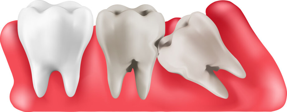 Illustration depicting a partially impacted wisdom tooth The image shows three molars, with the rearmost tooth positioned horizontally and pressing against