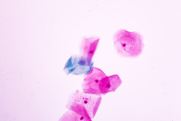Abnormal squamous epithelial cells on white background view in microscopy.Atypical epithelial cells...