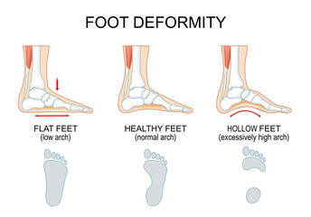 Foot deformity. Healthy feet, Flat feet and hollow