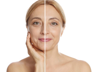 Woman showing face before and after collagen consumption on white background. Collage of photos...
