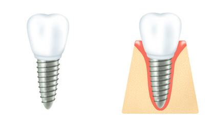 Dental implants, artificial tooth roots, replacement teeth,  gum, and jawbone, Dentures, PNG, transparent background