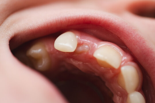 Orthodontist examining kid mouth. The tooth is growing in the wrong place