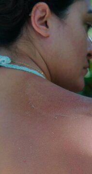 Close up of neck and shoulder of woman who got sunburnt while on vacation. Her shoulder is red and peeling. Trouble during vacation in hot country. Sun protection. Safe tanning.