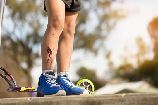 Dried blood on kid's leg with scooter