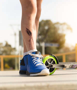 Dried blood on the shin of a kid with a scooter